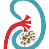 Kidney Stones Treatment Guide