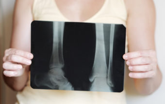 Osteoporosis Treatment Guide