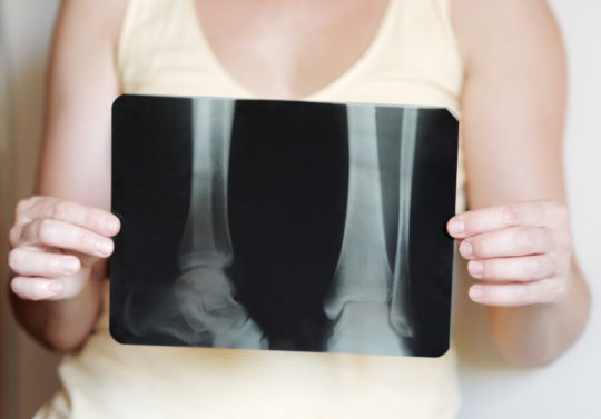 Who Is Most at Risk for Developing Osteoporosis?